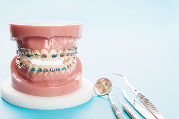 Ortodoncia ¿Qué es? ¿Invisalign o Brackets?