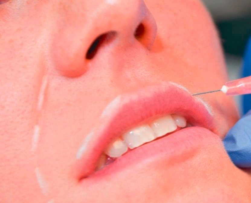 uso de ácido hialurónico en odontología