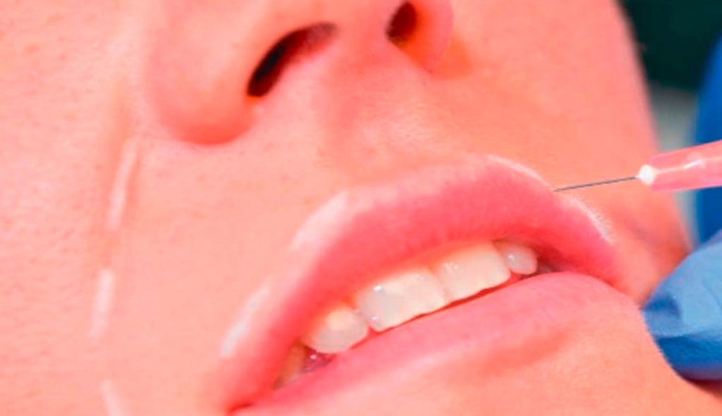 Ácido hialurónico en odontología