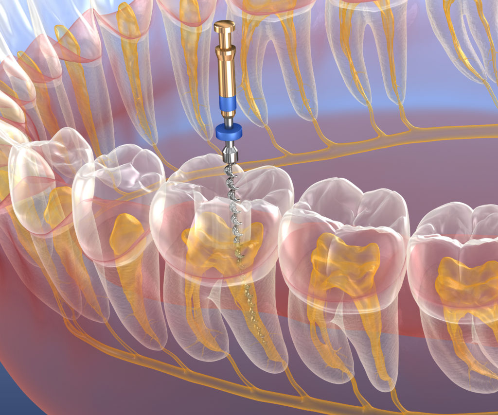 Endodoncia-clinica-dental-sonia-jimenez