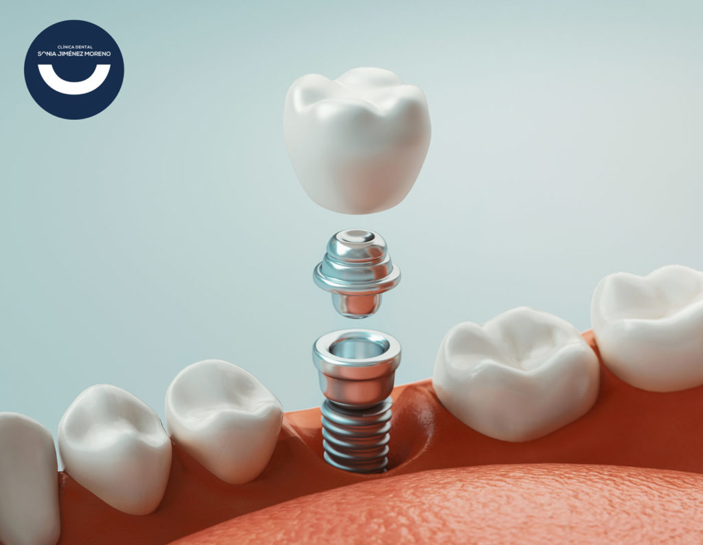 tipos de implantes dentales y precios - Sonia Jiménez - dentista plasencia