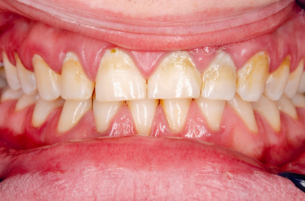qué es la placa bacteriana - como combatirla -dentista Plasencia