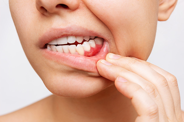 enfermedades periodontales - tratamiento y tipos