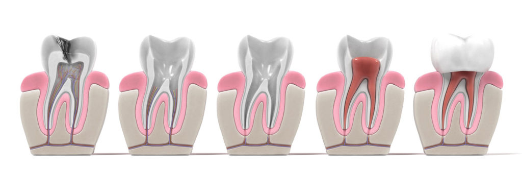 como se hace una endodoncia paso a paso - procedimiento de la endodoncia