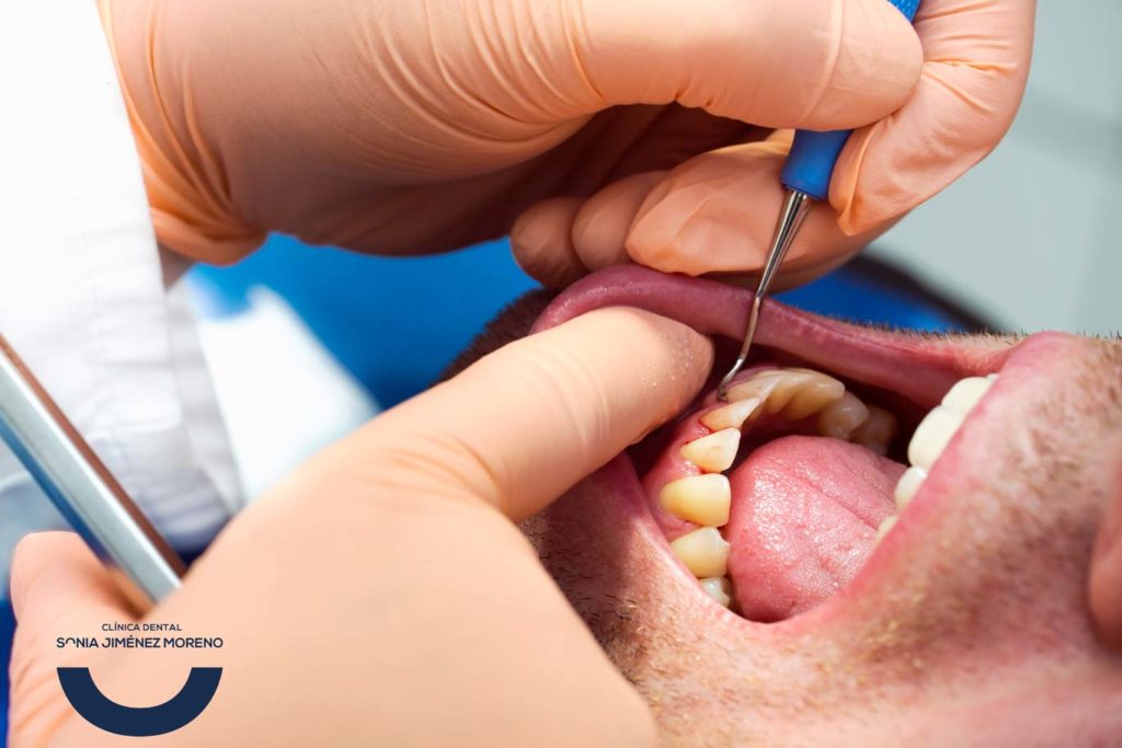 periodontitis que es, causas y tratamientp