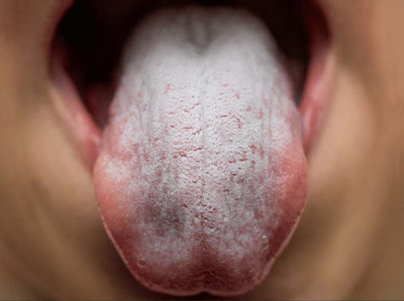 hongos en la boca fotos - candidiasis oral