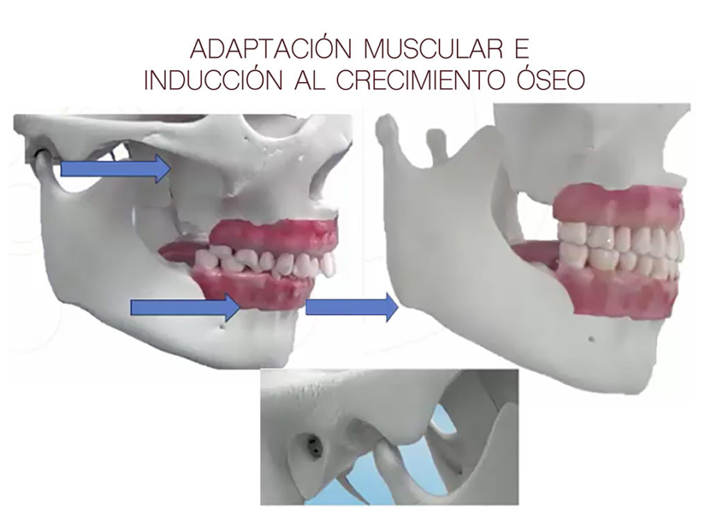 ortodoncia invisible para niños