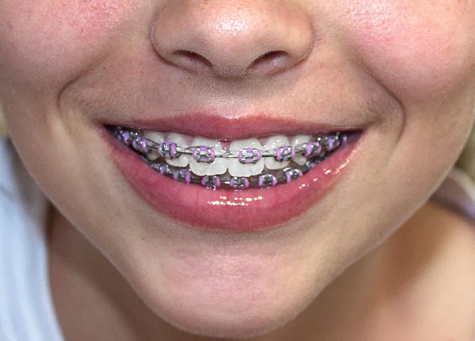 Brackets niños