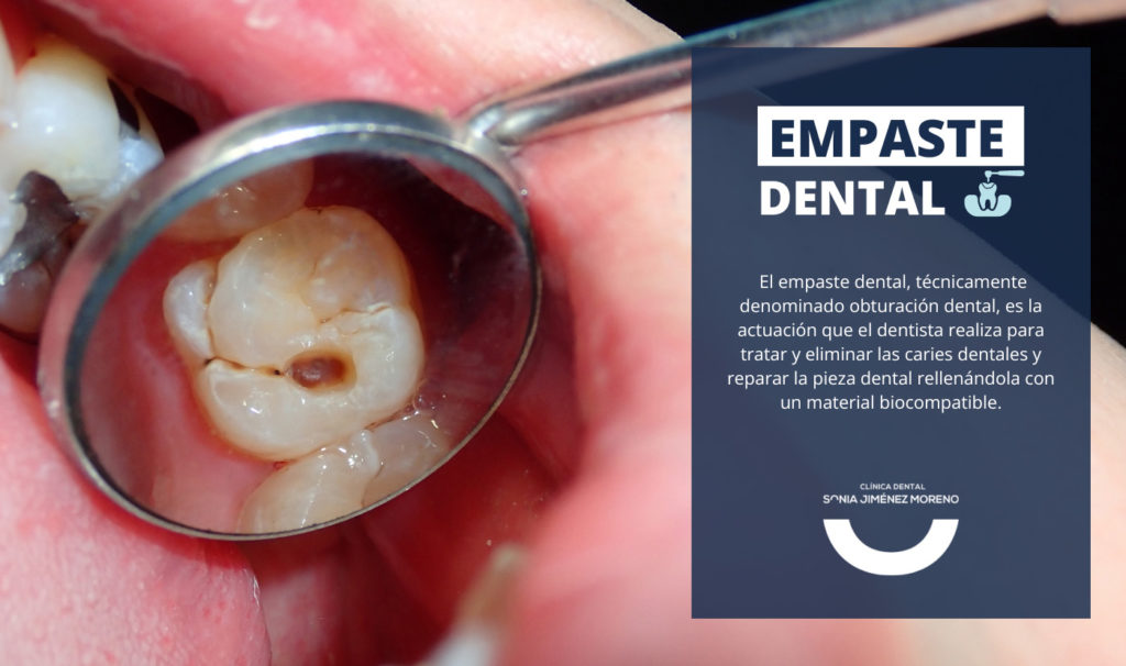 Empaste dental: Precio, qué es y cómo se realiza