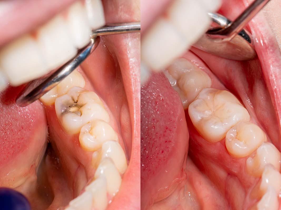 empaste dental, antes y después